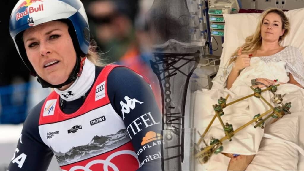 Falling at Full Speed: Lindsey Vonn’s Harrowing Olympic Downhill Crash, Painful Recovery, and Unbroken Spirit Falling at Full Speed: Lindsey Vonn’s Harrowing Olympic Downhill Crash, Painful Recovery, and Unbroken Spirit